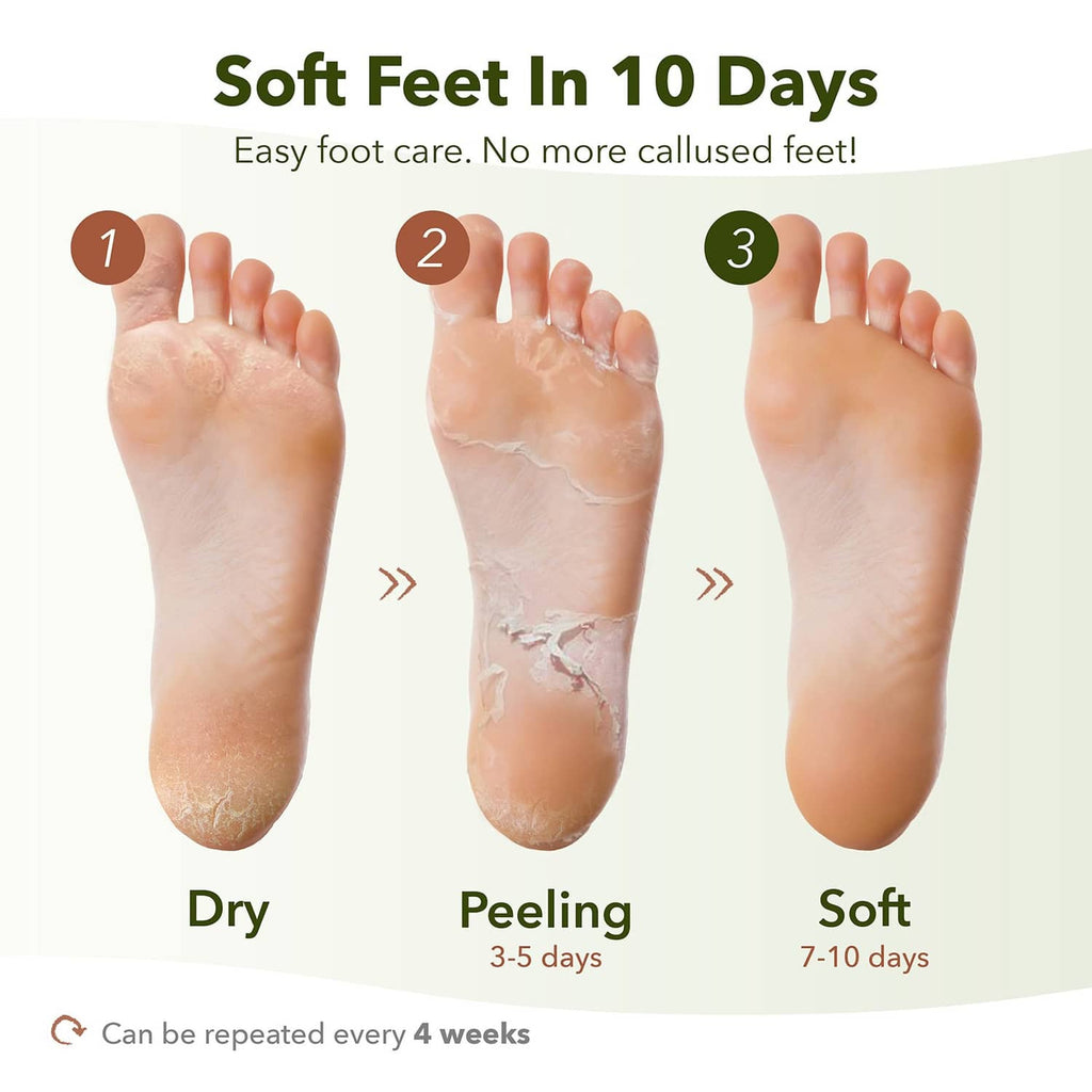 Foot peeling mask results over 10 days: dry, peeling, then soft feet