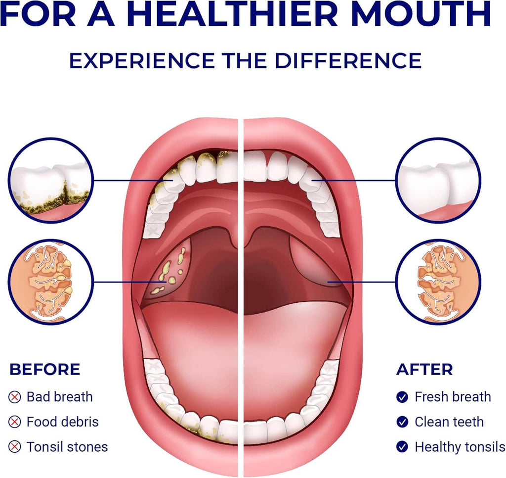 Water flosser before-and-after mouth diagram with healthy tonsils and cleaner teeth