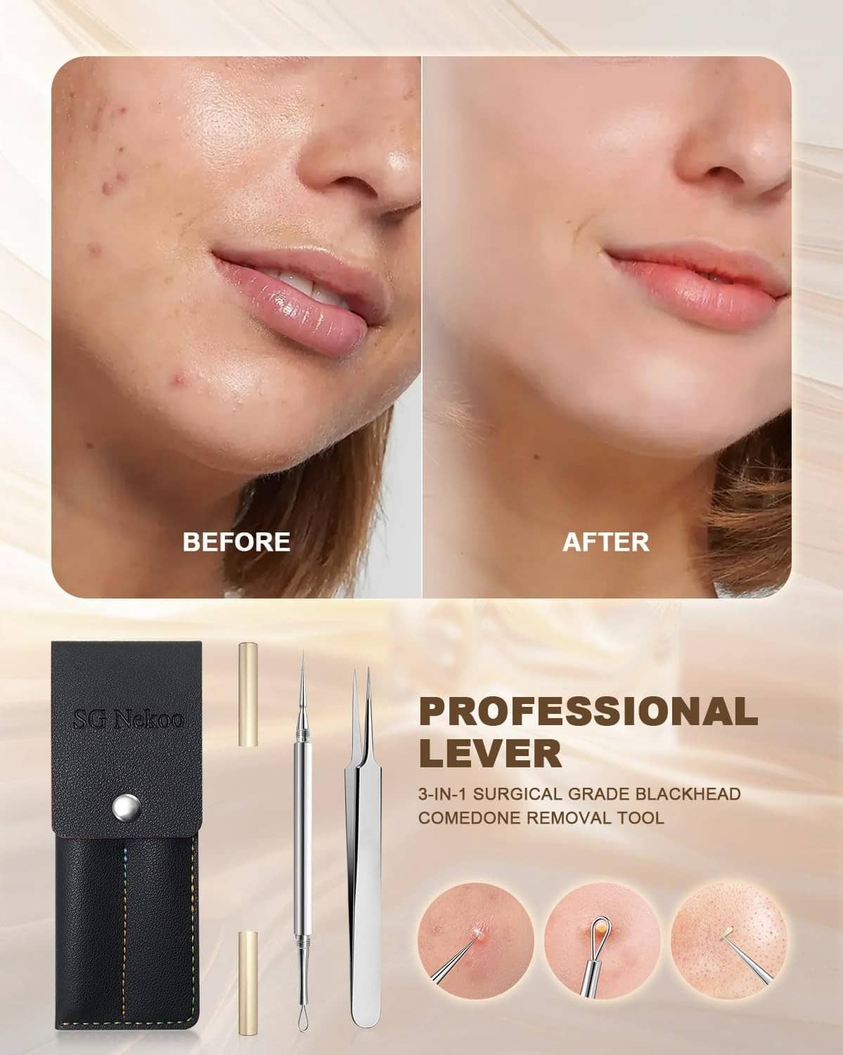 Facial pore extraction tool set with case and tips shown with before-and-after