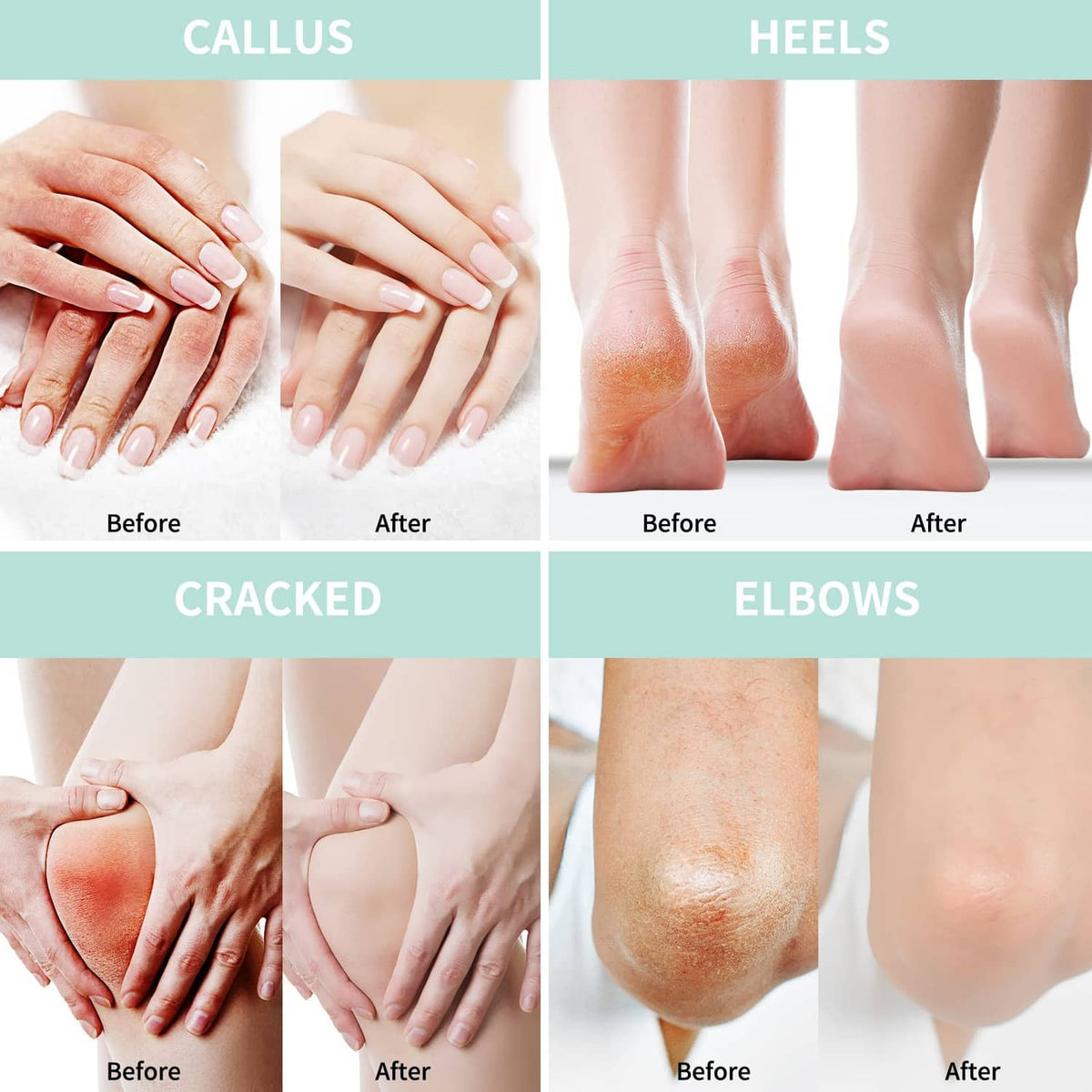Skincare before-and-after panels for callus and heels, showing smoother feet.
