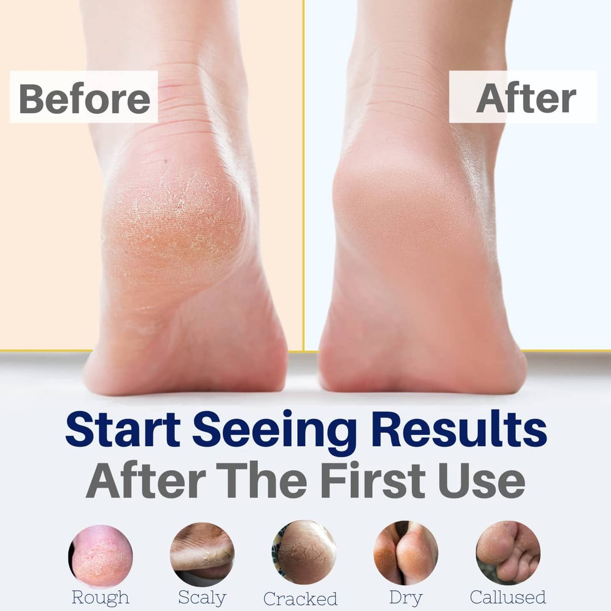 Foot cream applied on feet, before-and-after view of heels and soles
