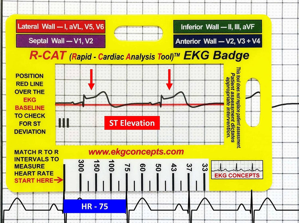 EKG analysis badge, yellow card with red ST elevation callout and heart rate scale